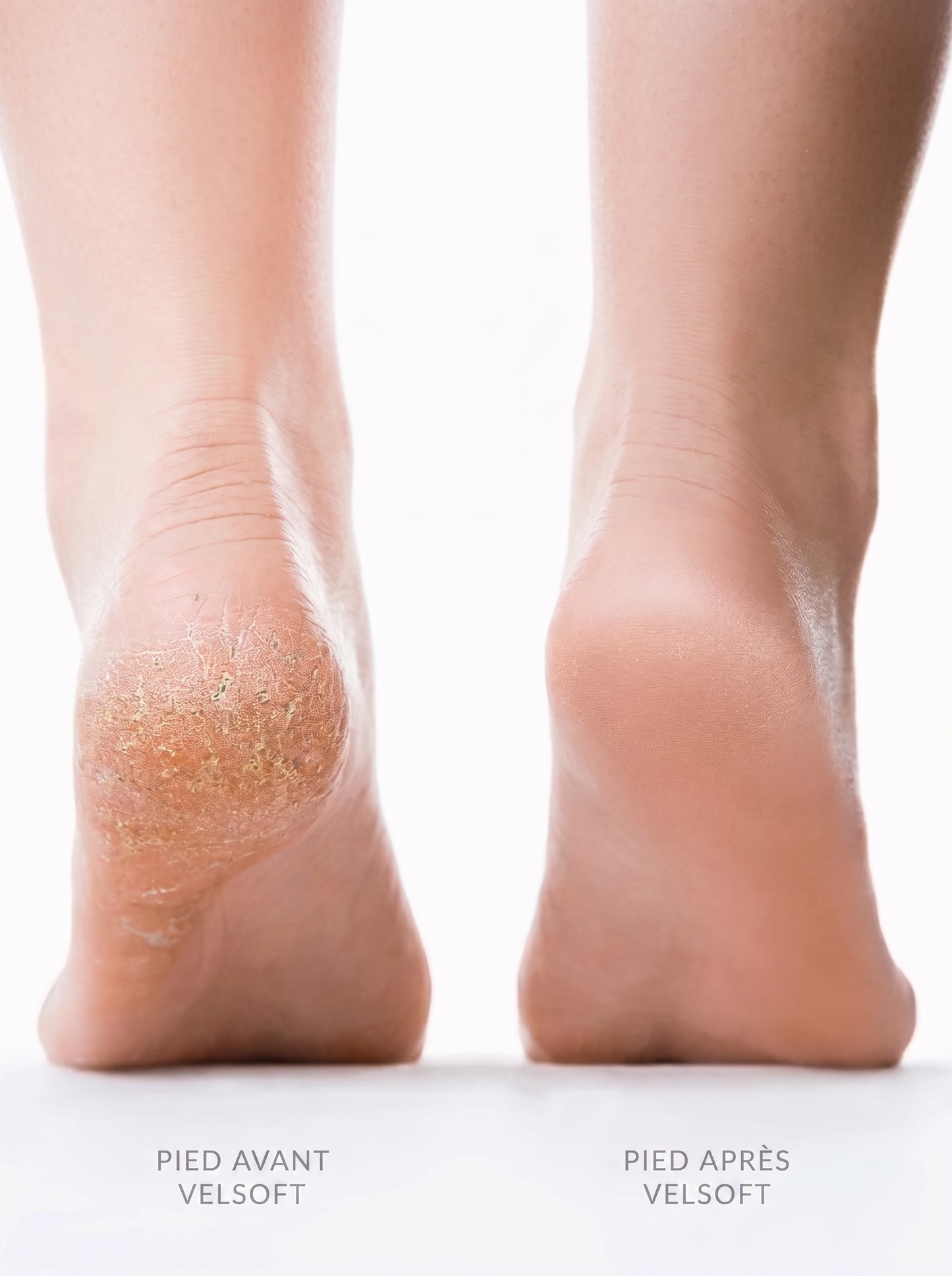VelSoft Pro — Electric Callus Remover